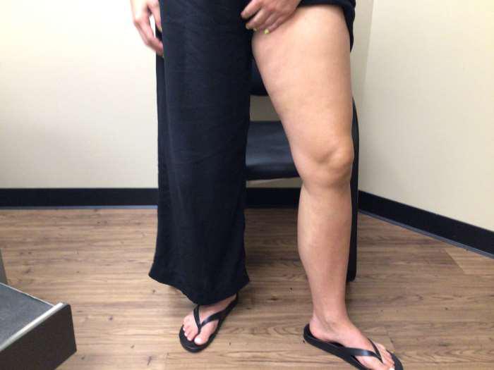 After Image: Bulging Varicose Veins - right-front-oblique