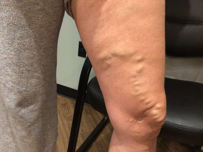 Before Image: Bulging Varicose Veins - right-front-oblique