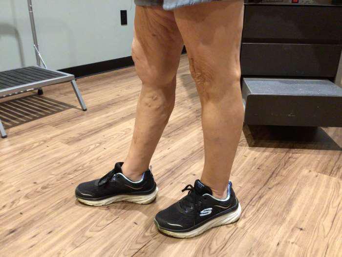 After Image: Bulging Varicose Veins - left-front-oblique