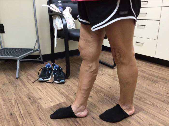 Before Image: Bulging Varicose Veins - left-front-oblique