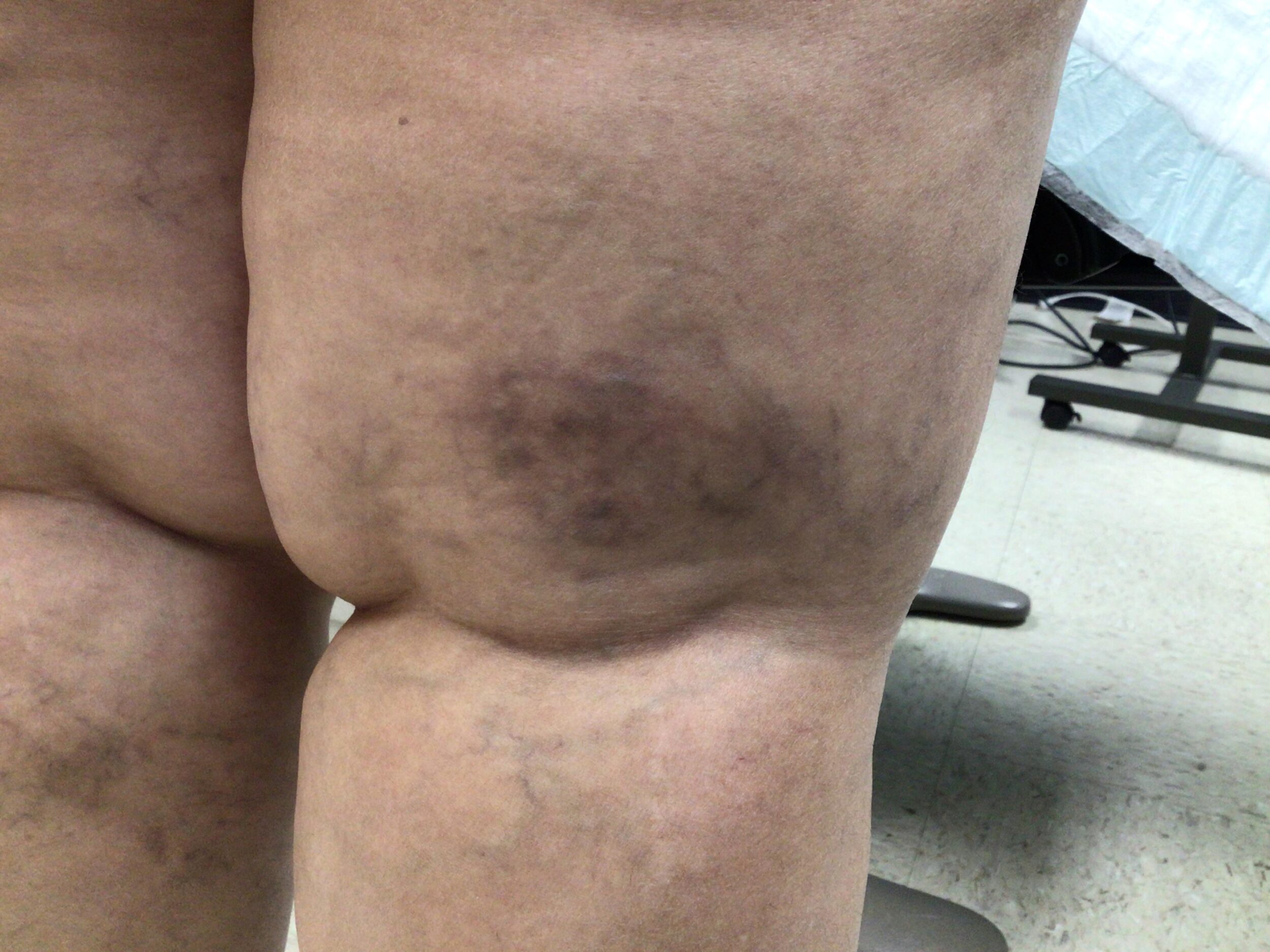 After Image: Spider Veins - back