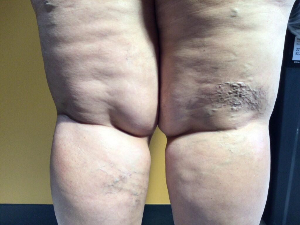 Before Image: Spider Veins - back
