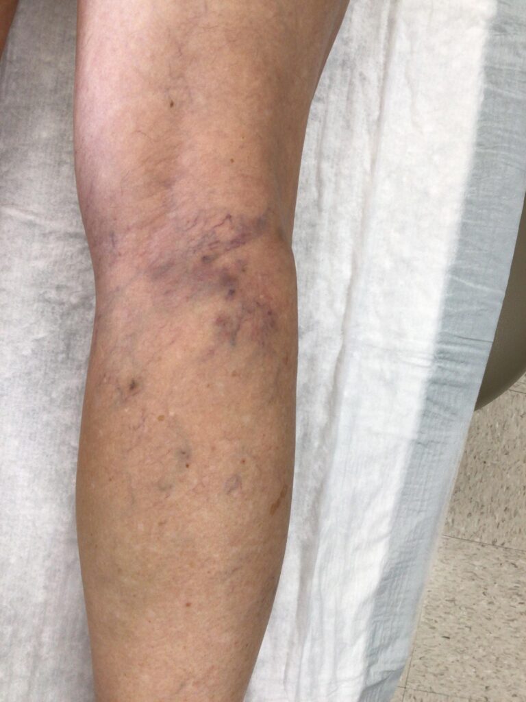 After Image: Spider Veins - back