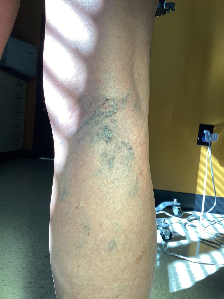 Before Image: Spider Veins - back
