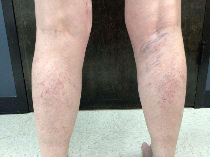 After Image: Spider Veins - back
