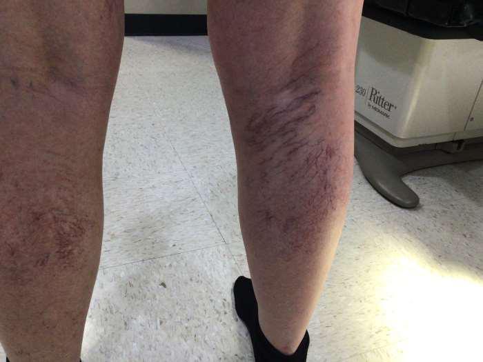 Before Image: Spider Veins - back