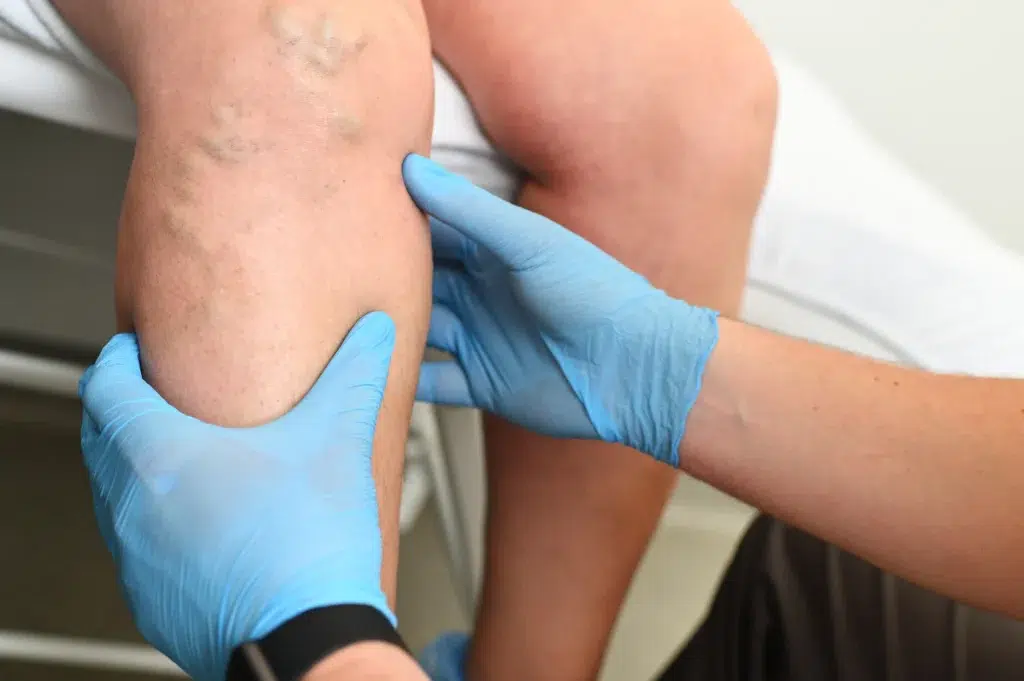 Doctor examining the thick, enflamed varicose veins on a patient's legs before treatment.