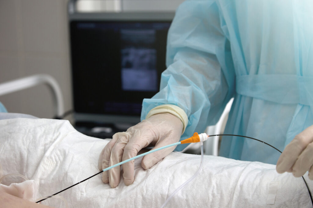 Close up of a surgeon performing an endovenous thermal ablation to treat a patients varicose veins